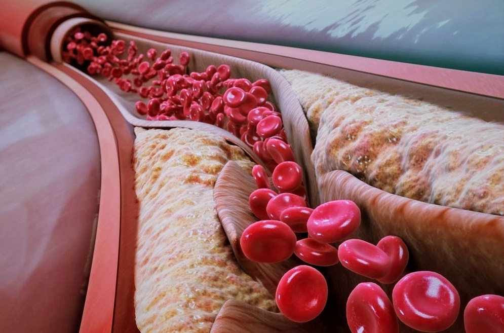 アテローム性動脈硬化症：危険因子と予防
